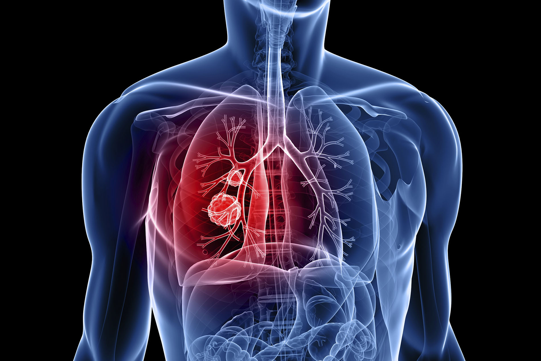 Tumore al polmone: scoperte nuove cellule per sconfiggerlo