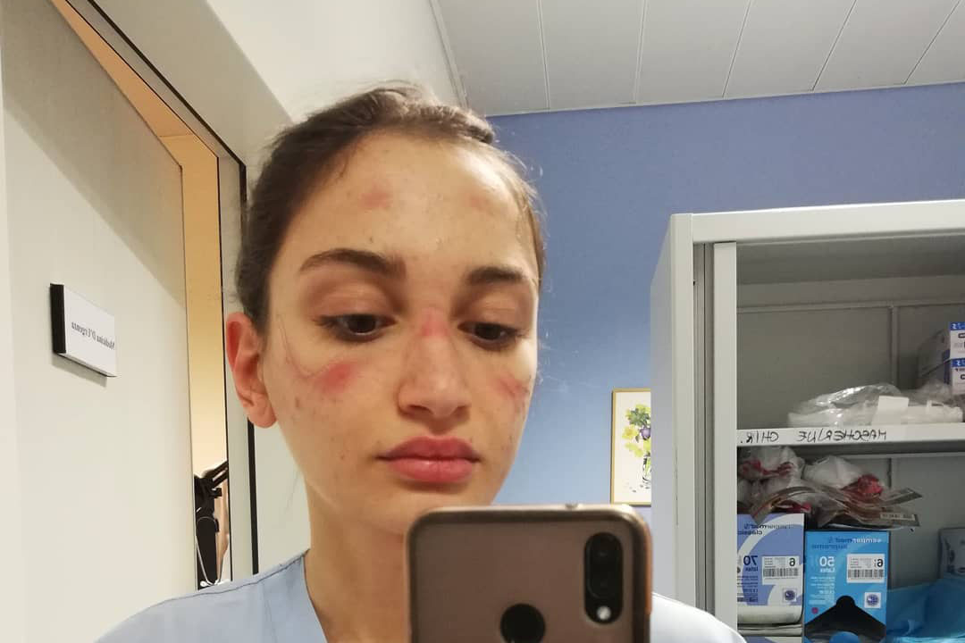 Alessia Bonari infermiera di grosseto con i segni della maschierina, cicatrici comprese, sul volto