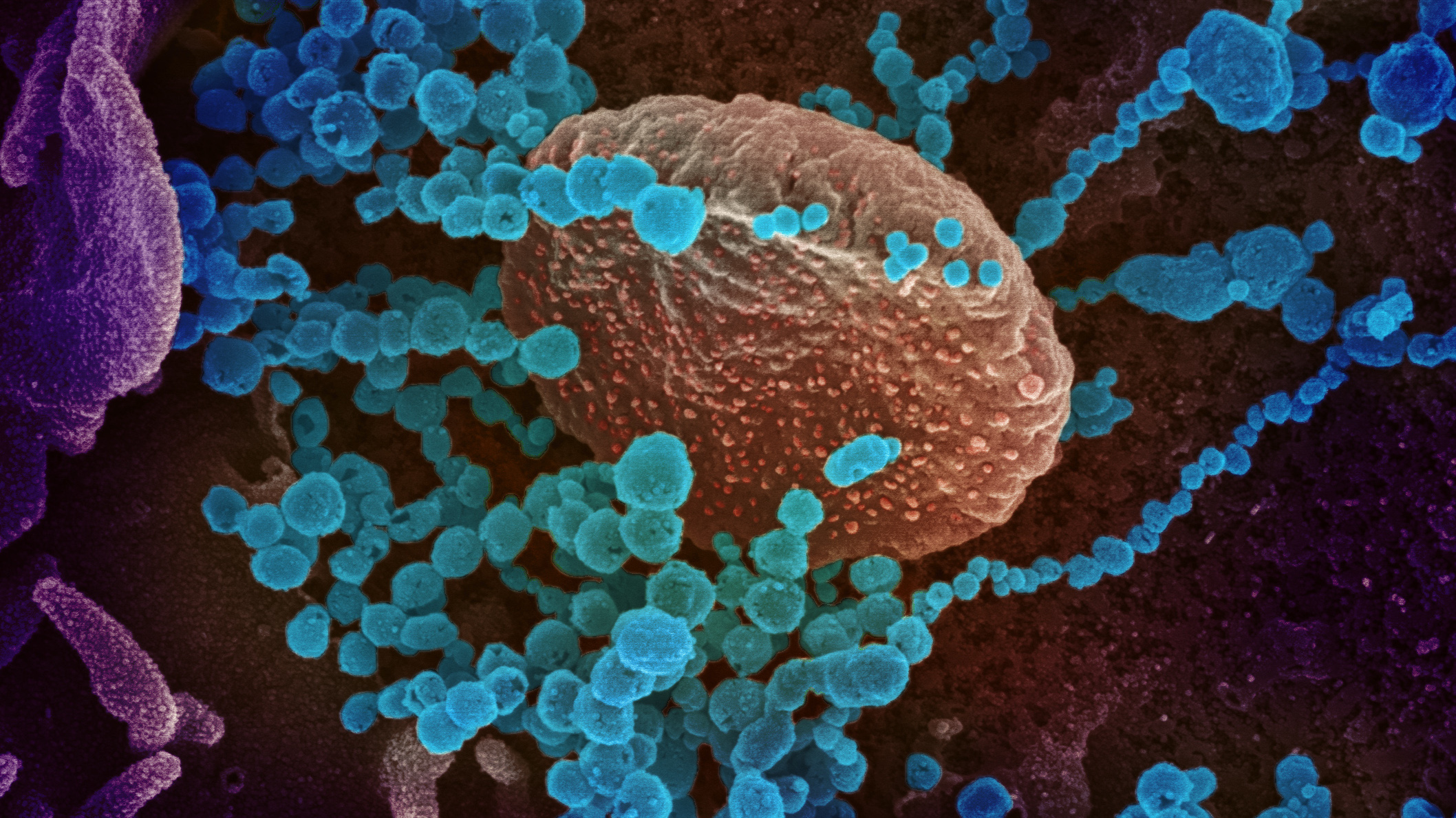 Il coronavirus attacca una cellula coltivata in laboratorio