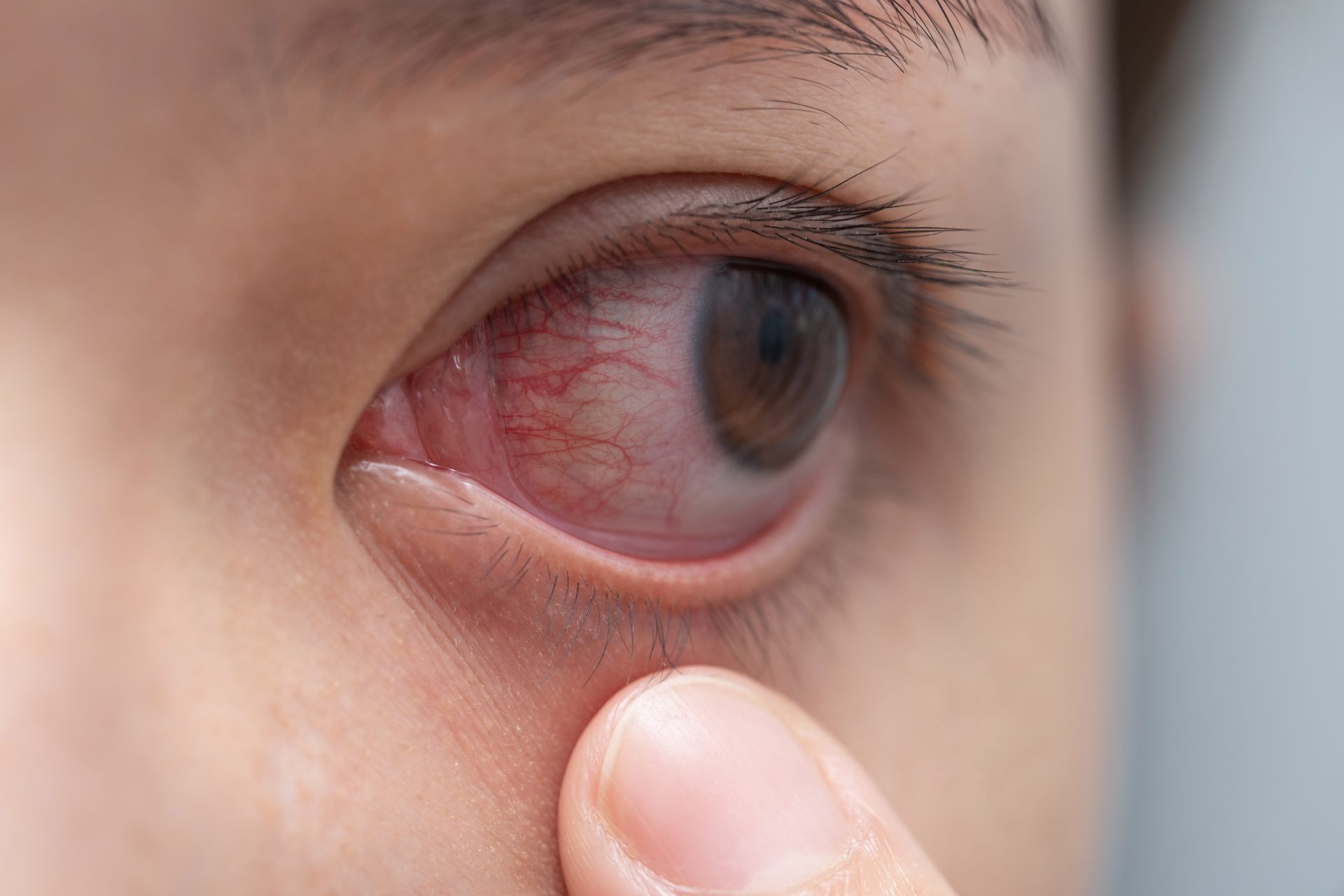closeup of irritated or infected red bloodshot eye conjunctivi