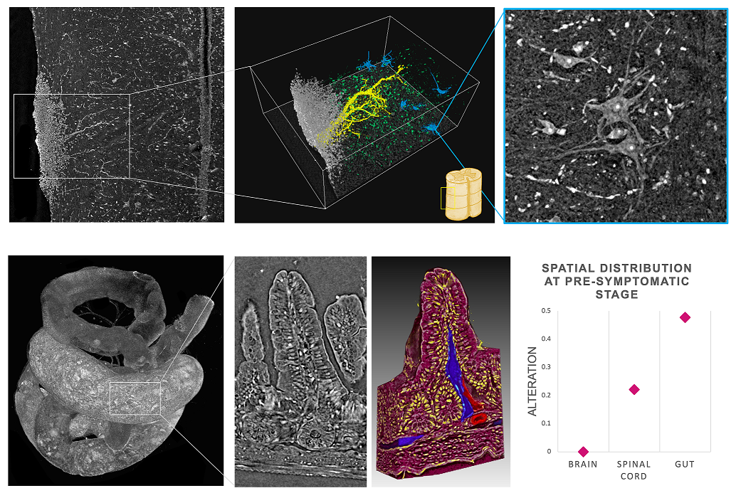 Comprendere le malattie neurodegenerative con i raggi X